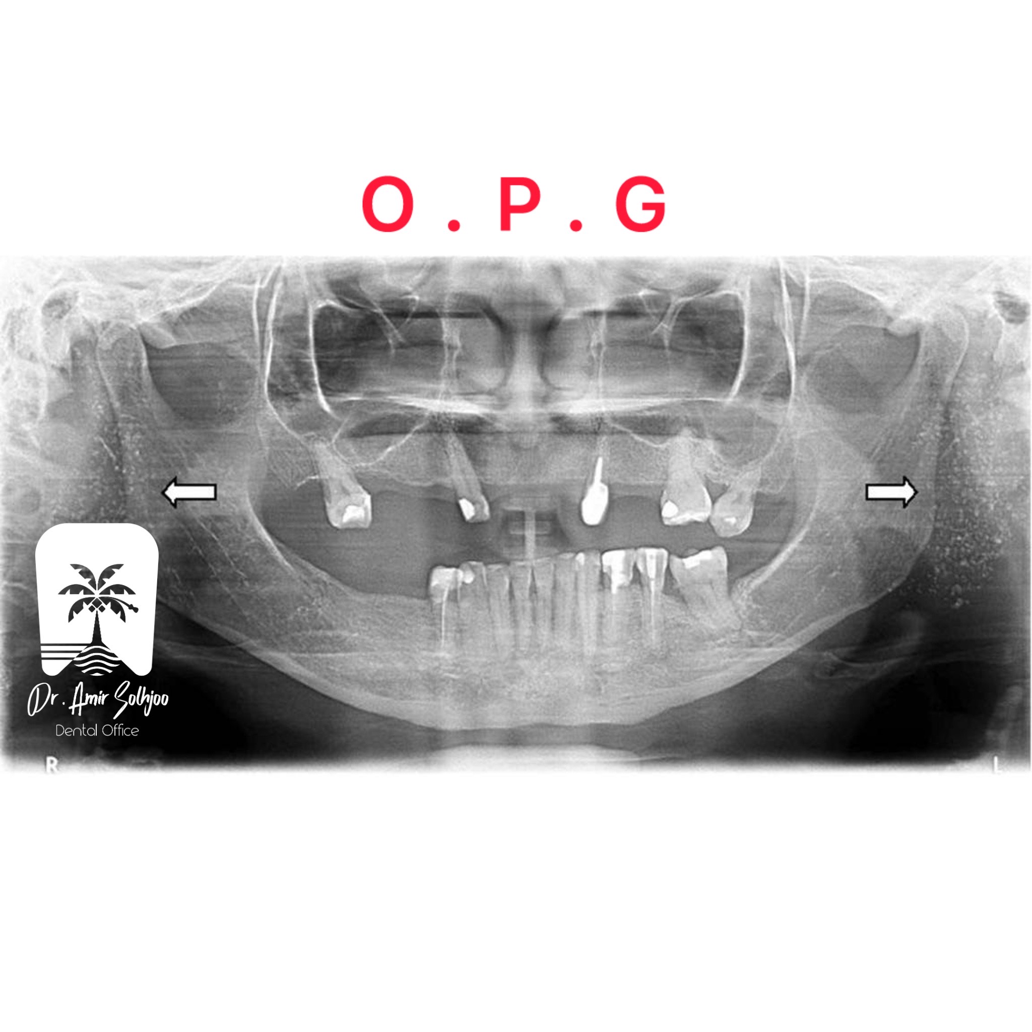 عکس OPG