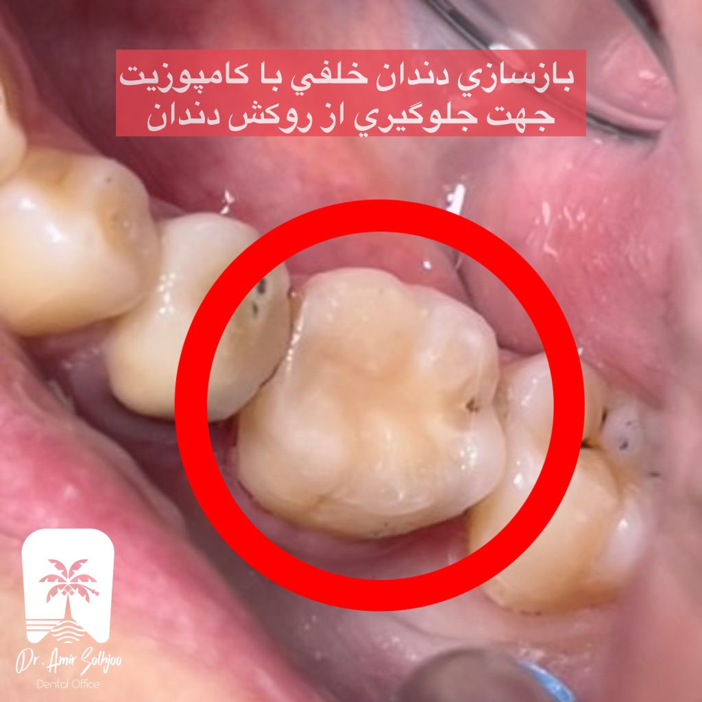بازسازی دندان خلفی