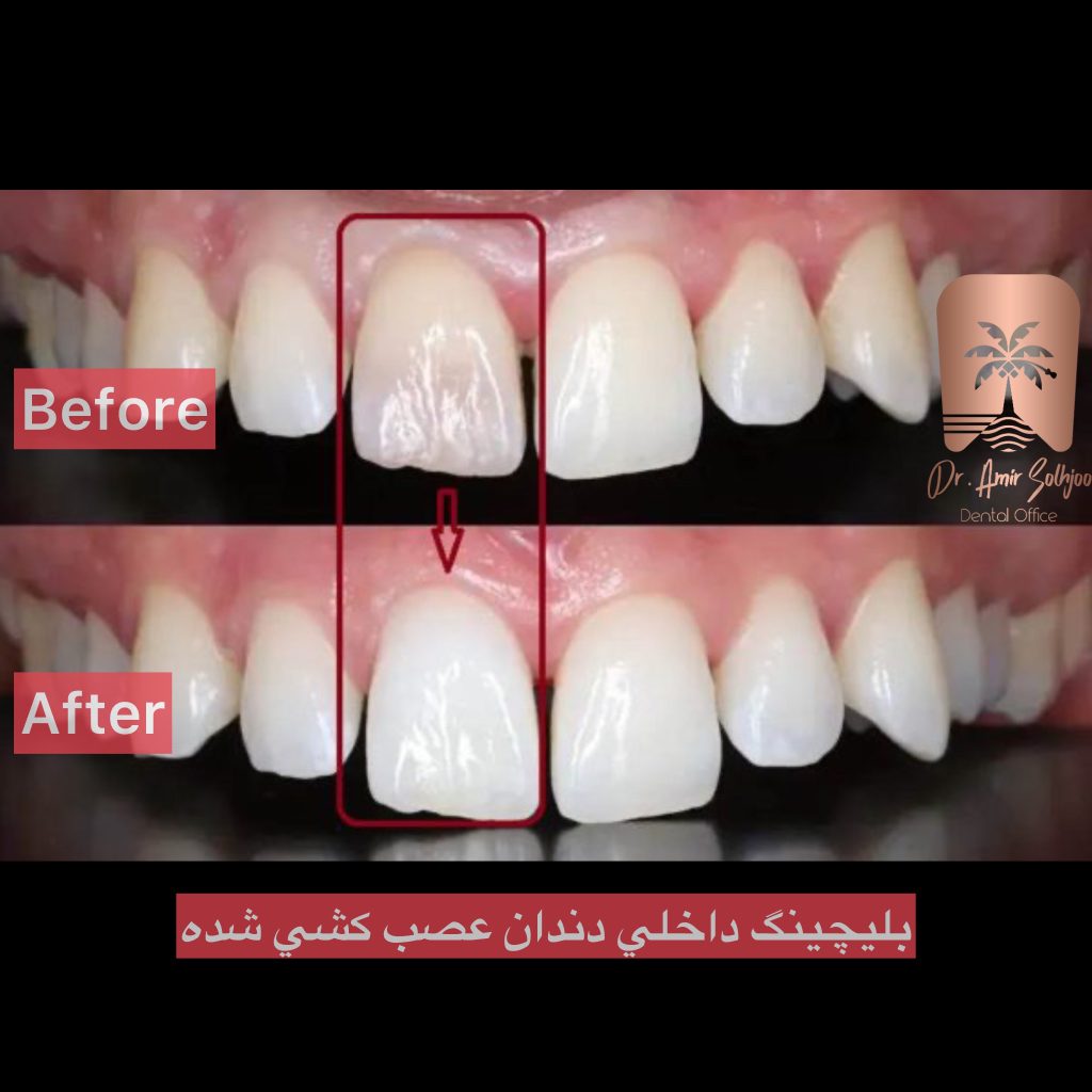 اندو بلیچینگ چیست