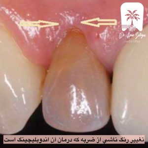 تغییر رنگ دندان