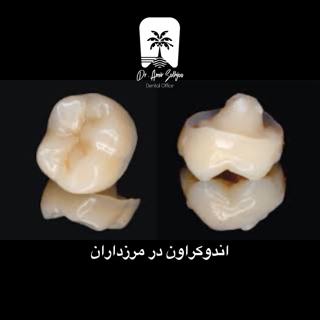 اندوکراون در مرزداران