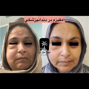 روش‌های تخلیه و درمان آمفیزم