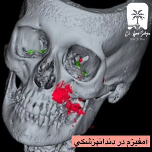 علل بروز آمفیزم