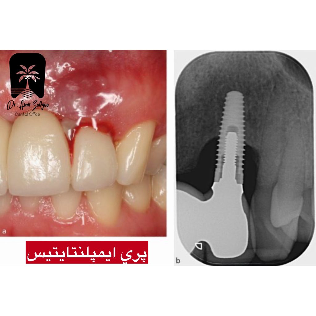 پری ایمپلنتایتیس