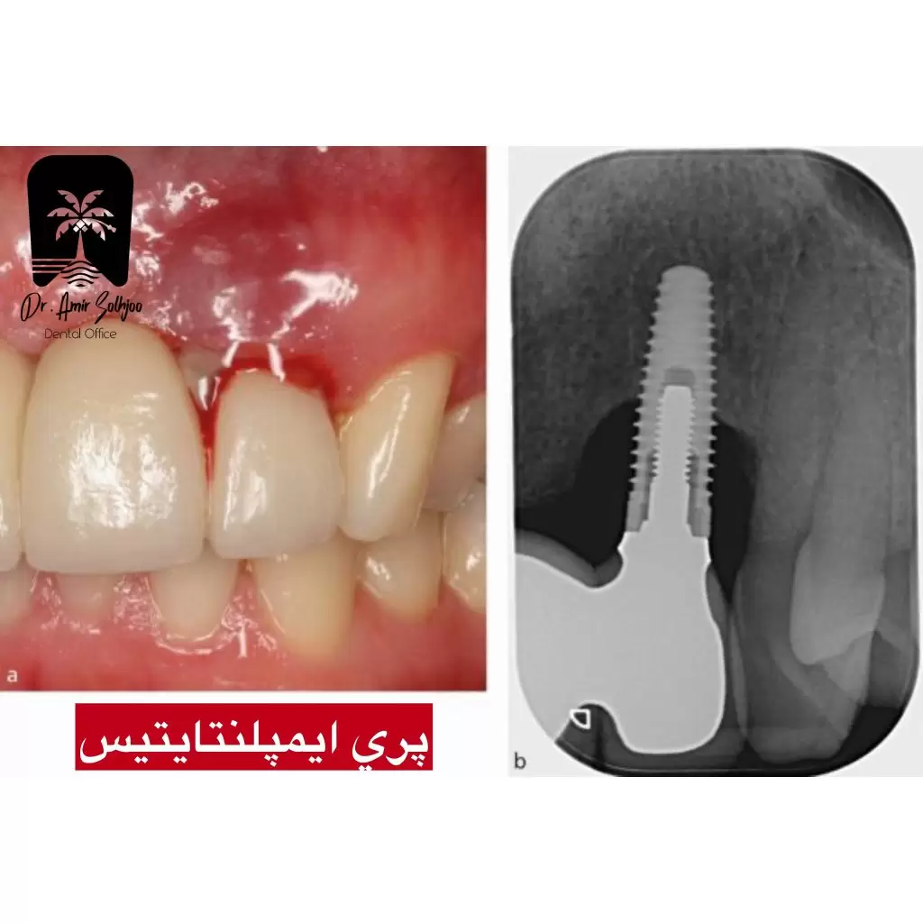 پری ایمپلنتایتیس