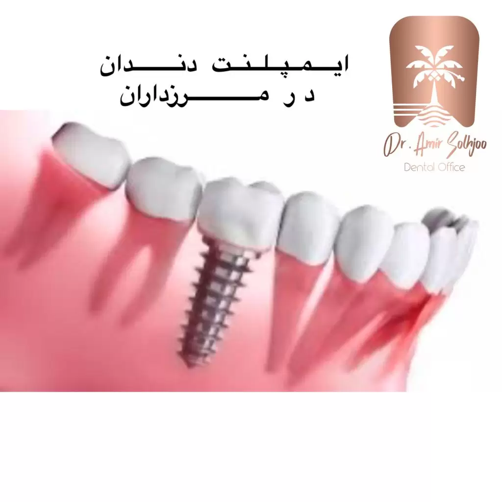 تحقیقات و پیشرفتهای نوین در ایمپلنت دندان