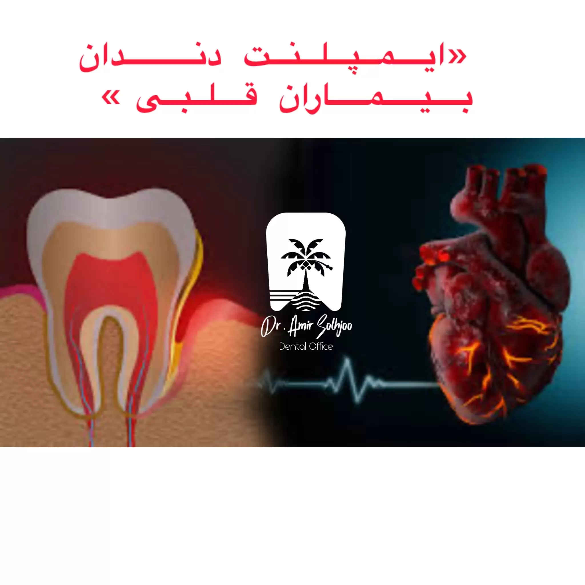 ایمپلنت دندان بیماران قلبی