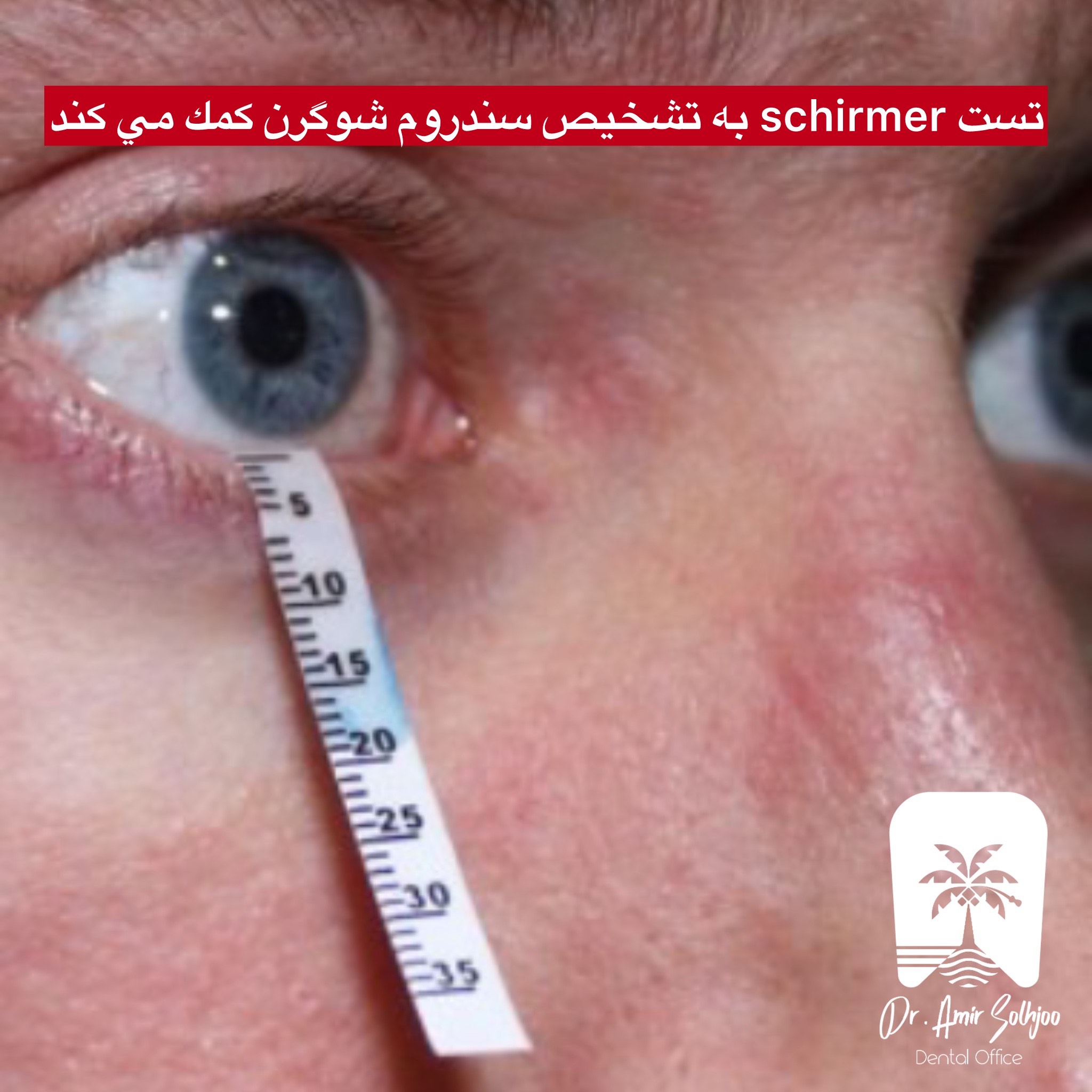آزمایشهای تشخیصی سندروم شوگرن