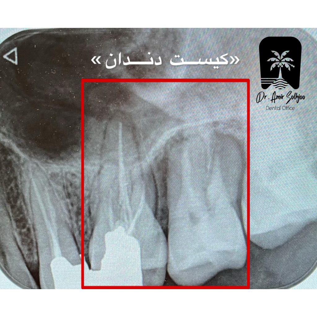عکس کیست دندان