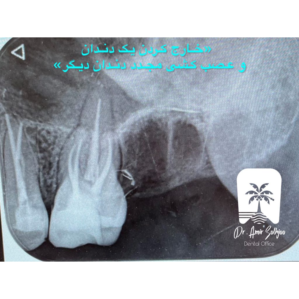 علت به وجود آمدن کیست دندان
