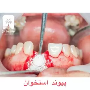 پیوند استخوان