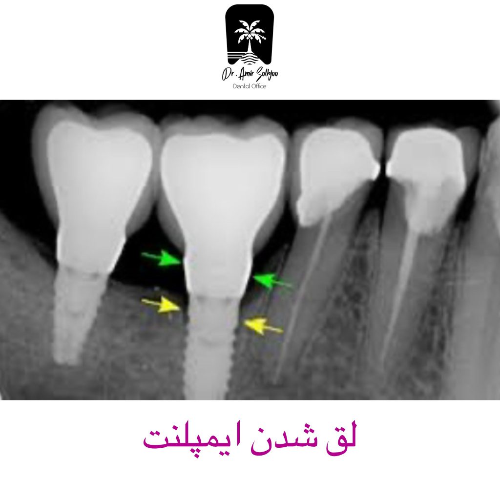 لق شدن ایمپلنت