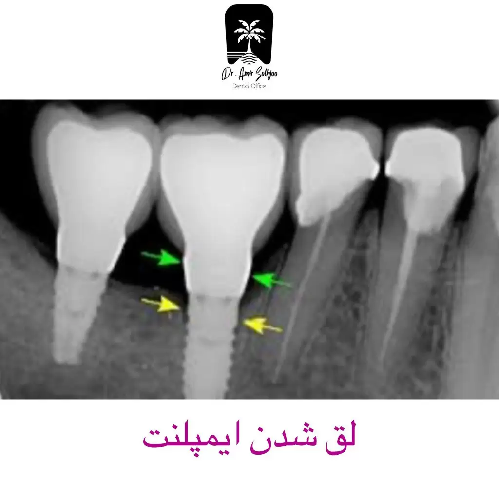 لق شدن ایمپلنت
