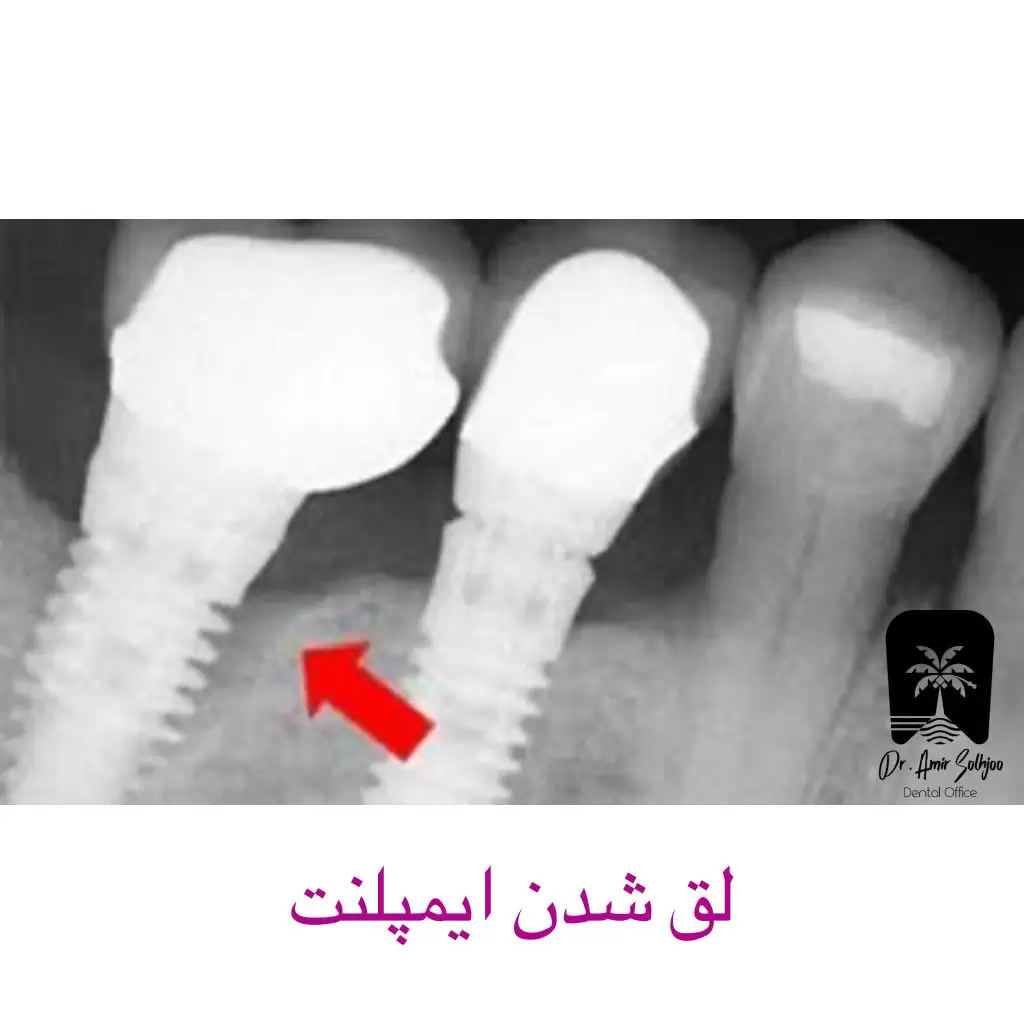 لق شدن ایمپلنت