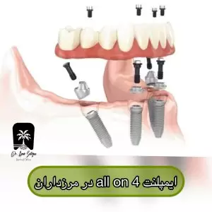 ایمپلنت کامل فک بالا و پایین