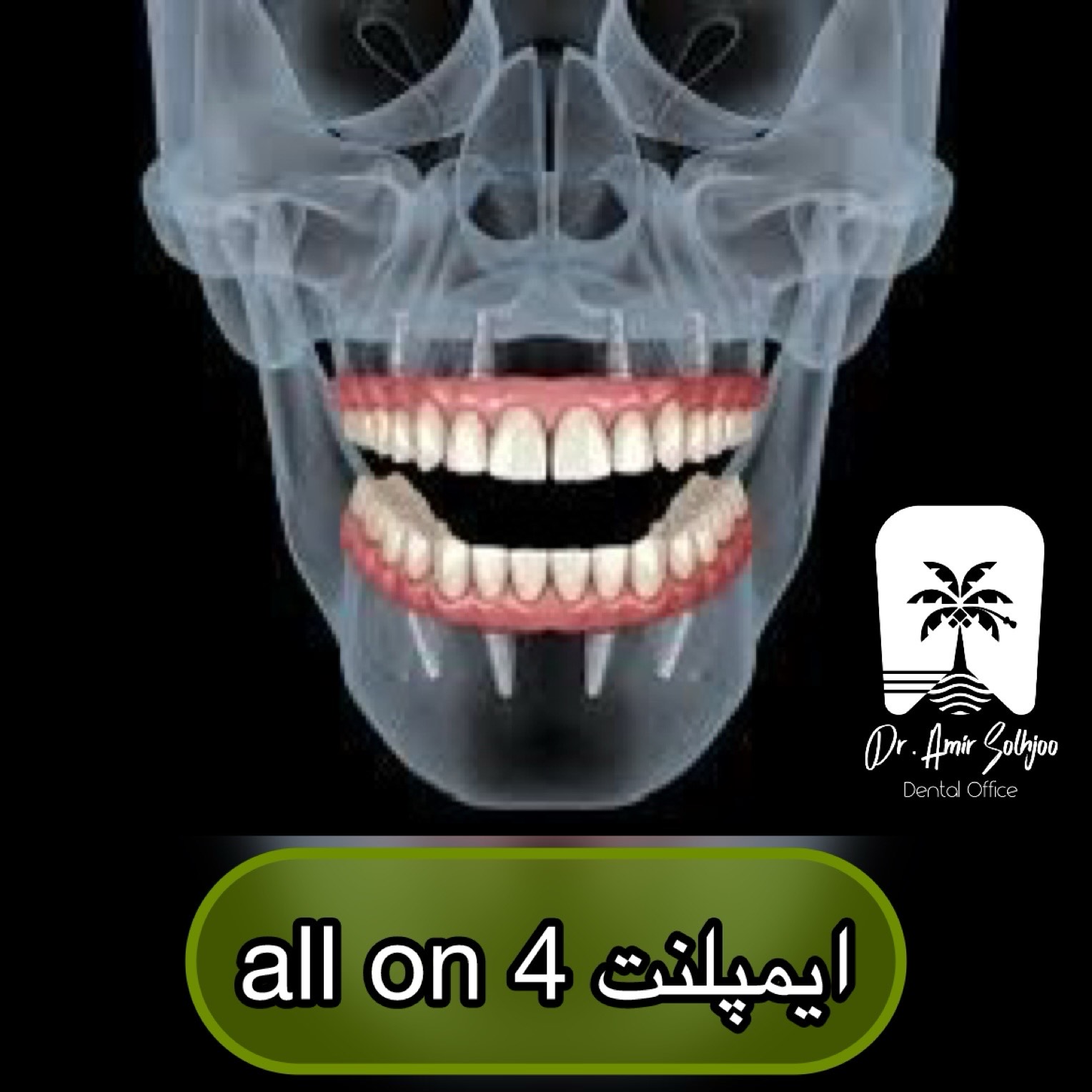 ایمپلنت 4 دندان بالا