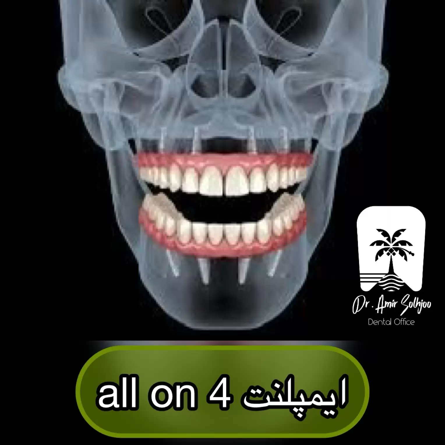 ایمپلنت 4 دندان بالا