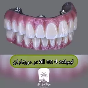 ایمپلنت All-on-4