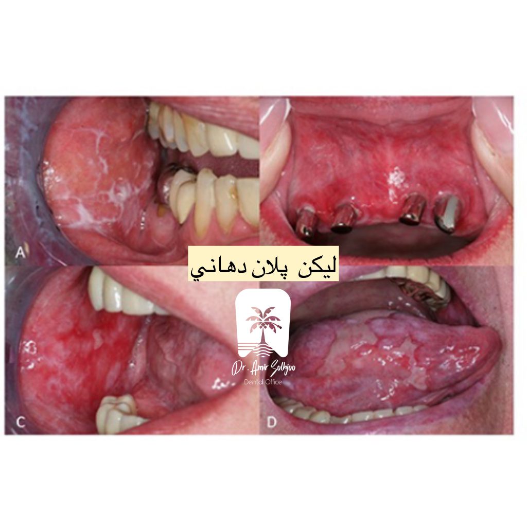 علائم لیکن پلان دهانی