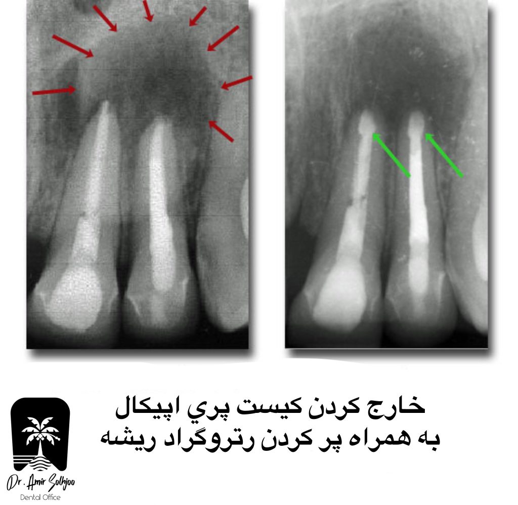 خارج کردن کیست پری اپیکال