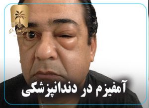 آمفیزم چیست