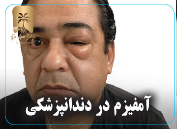 آمفیزم
