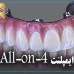 ایمپلنت All-on-4