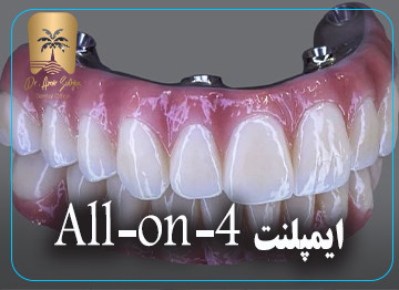 ایمپلنت All-on-4