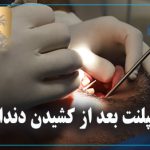ایمپلنت بعد از کشیدن دندان