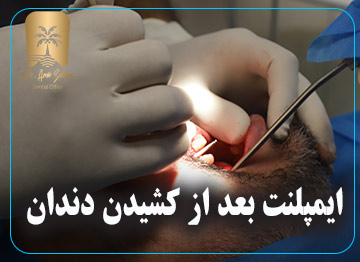 ایمپلنت بعد از کشیدن دندان