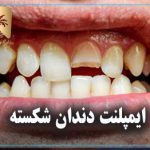 ایمپلنت دندان شکسته