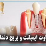 تفاوت ایمپلنت و بریج دندان