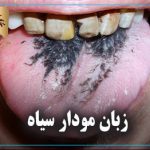 زبان مودار سیاه