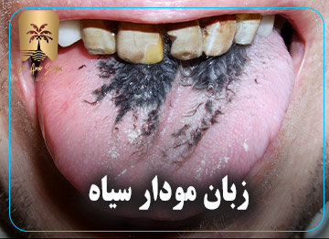 زبان مودار سیاه