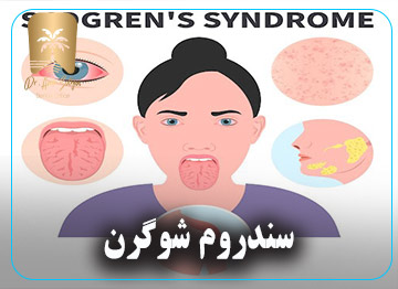 سندروم شوگرن