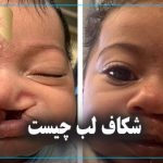 شکاف لب چیست