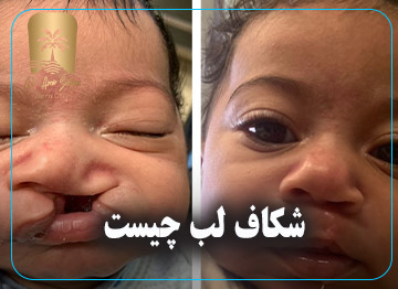 شکاف لب چیست