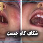 شکاف کام چیست