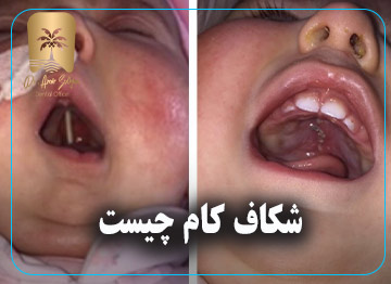 شکاف کام چیست