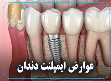 عوارض ایمپلنت دندان