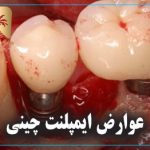 عوارض ایمپلنت چینی