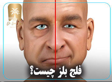 فلج بلز