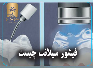 فیشور سیلانت چیست