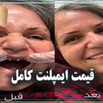 قیمت ایمپلنت کامل
