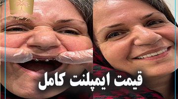 قیمت ایمپلنت کامل
