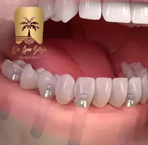 قیمت ایمپلنت کامل فک بالا و پایین