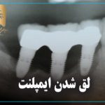 لق شدن ایمپلنت