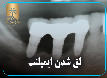 لق شدن ایمپلنت
