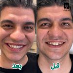 لیرینگ دندان