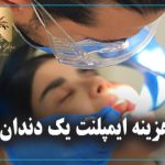 هزینه ایمپلنت یک دندان